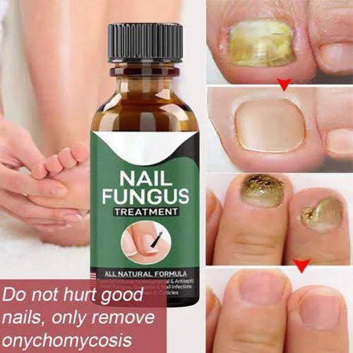 Nail Fungus Solution Fast Acting Antifungal Treatment for Healthy Nails